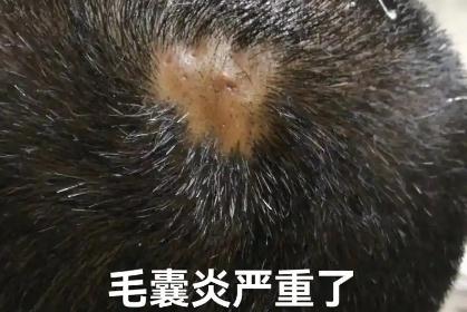 頭皮毛囊炎掛哪個(gè)科室的號(hào) 頭皮毛囊炎掛什么科室的號(hào)好