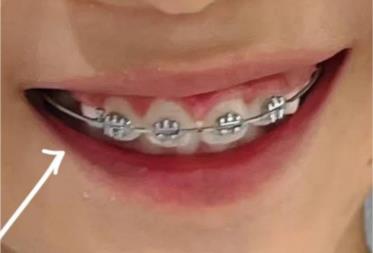 矯正牙齒可以報銷醫保嗎兒童(矯正牙齒可以報銷醫保嗎)