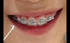 矯正牙齒可以報銷醫(yī)保嗎兒童(矯正牙齒可以報銷醫(yī)保嗎)