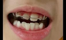 兒童矯正牙齒可以報(bào)銷嗎 兒童矯正牙齒可以用醫(yī)保卡嗎