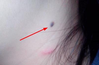 醫院祛痣掛什么科室 醫院祛痣掛什么科室的號