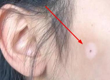 痣的周圍變白是為什么呢 痣的周圍變白是為什么呢