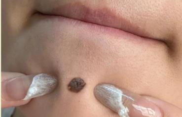 正規醫院取一顆痣多少錢 醫院祛痣一般多少錢一顆