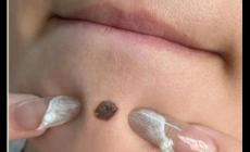 正規(guī)醫(yī)院取一顆痣多少錢 醫(yī)院祛痣一般多少錢一顆