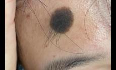 娘胎里帶來(lái)的黑色素胎記會(huì)惡變嗎 娘胎里的痣會(huì)掉嗎